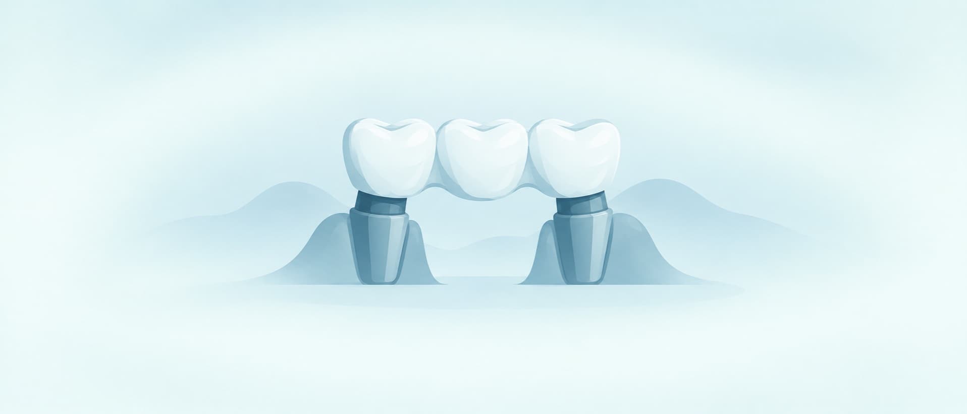 Three joined crowns resting on two abutment teeth, for dental bridge vs implant cost and per-unit pricing